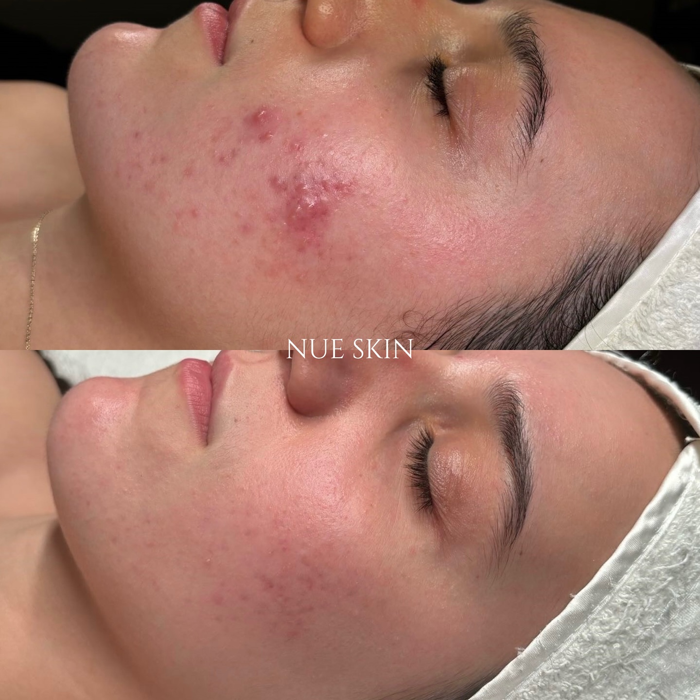 Cystic Cheek Acne Cleared — before and after