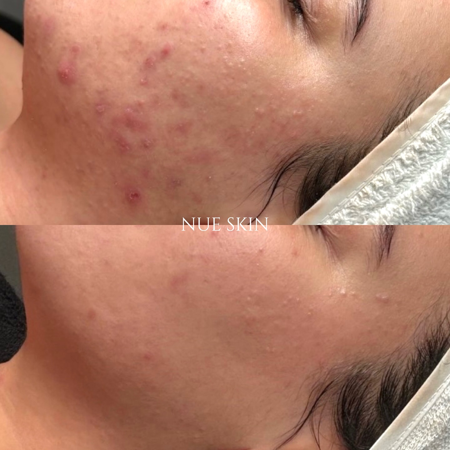 Jawline & Cheek Clearing — before and after